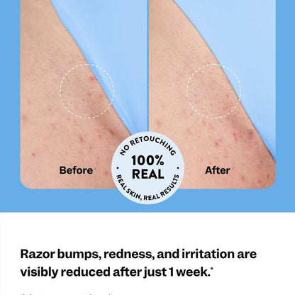 Glowline Razor Bump & Ingrown Hair Treatment